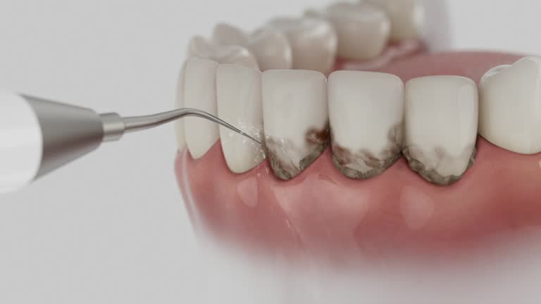 Trusted Dental Implants service in Langley Park, MD - Dentist Open Now